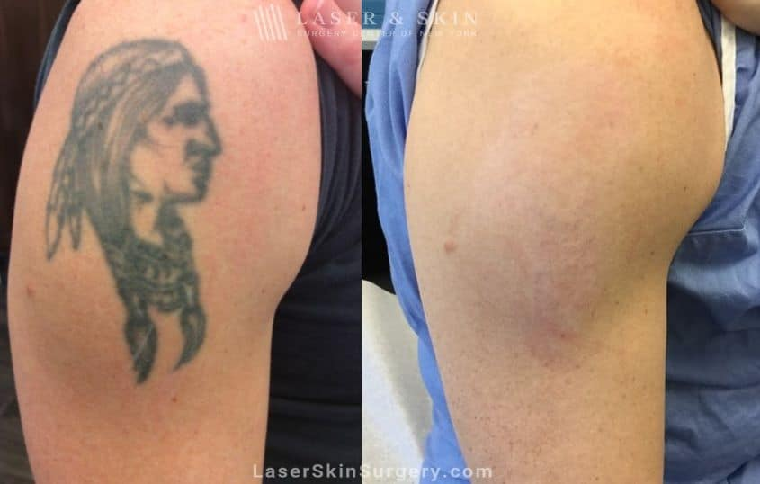 Complete tattoo removal result